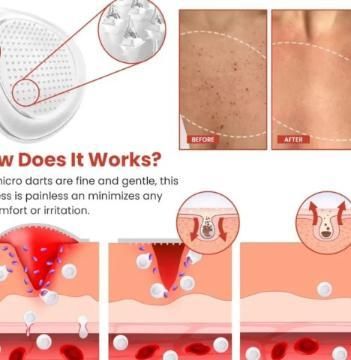 Skin Tag Remover Patch for Safe Skin Tag Treatment